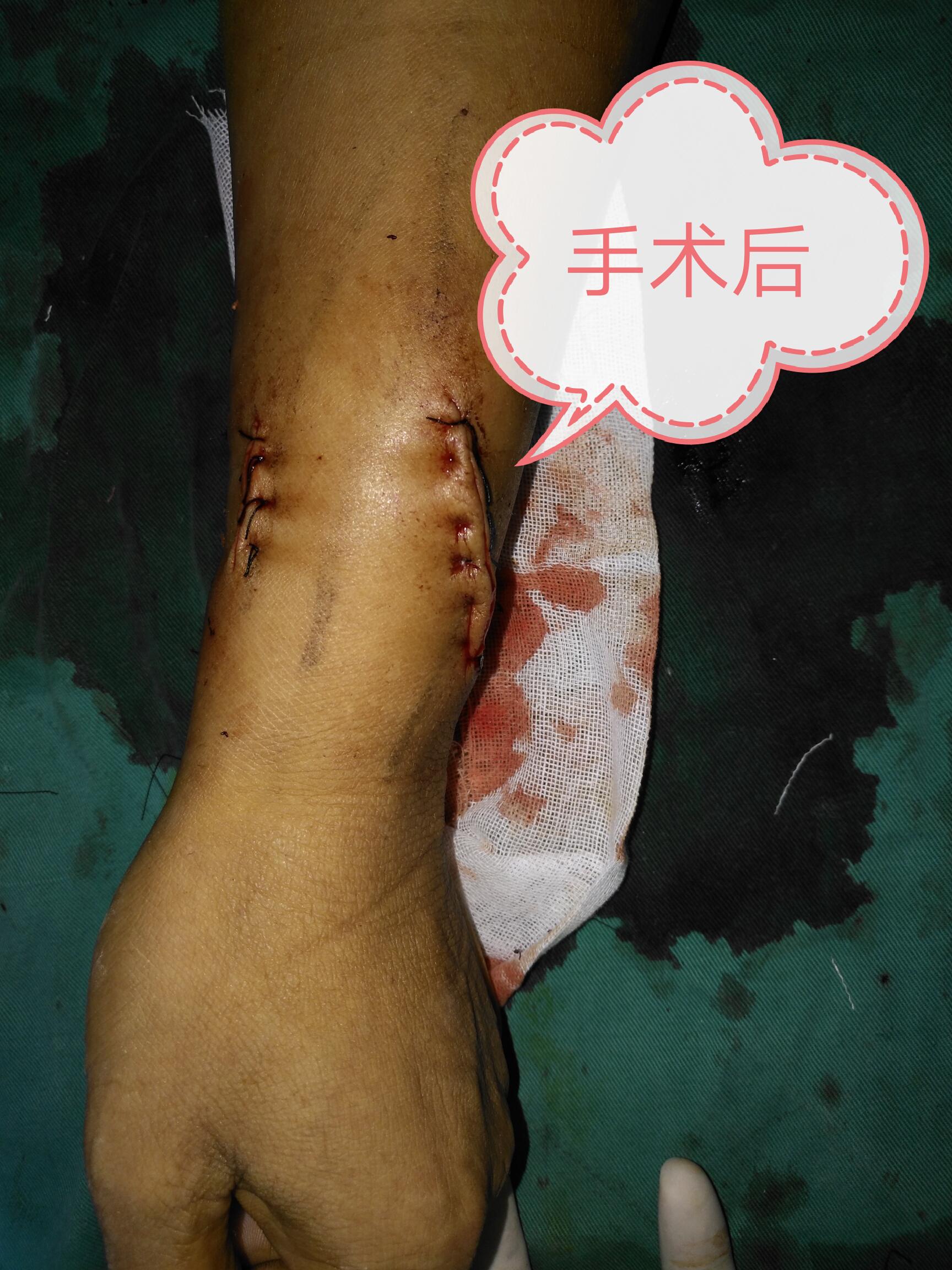 1534382693104486.jpg 血透室手术3.jpg